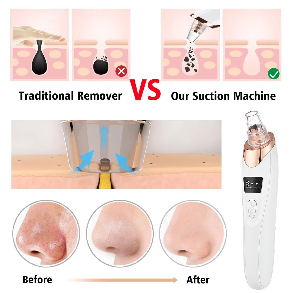 Face Vacuum Suction Blackhead Remover β Deep Pore Cleansing Device